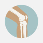 Osteoid osteoma: a propensity score matching study