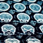 Posterior fossa stroke on brain CT