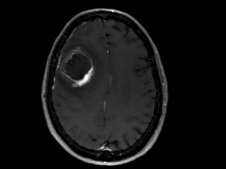 How reliable is MRI for the evaluation of treated high-grade gliomas?