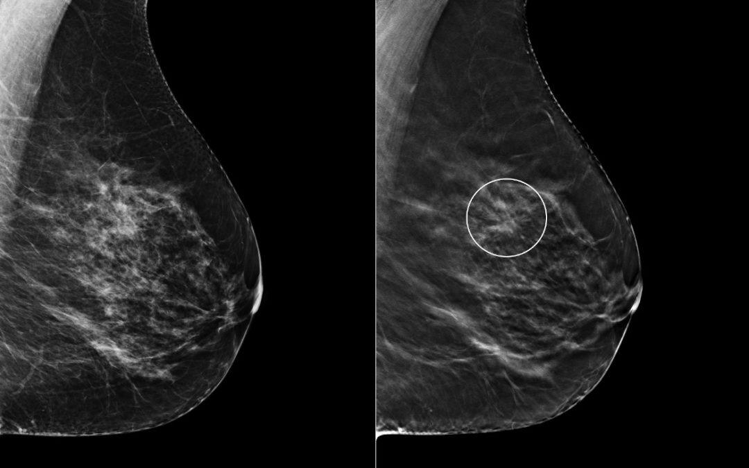 Tomosynthesis increases confidence