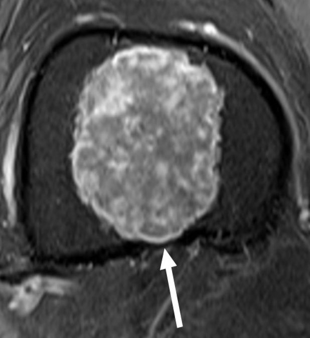 Enchondorma or Chondrosarcoma: not so easy!