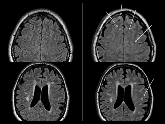 Synthetic MRI images. Are they valuable for the evaluation of multiple sclerosis?