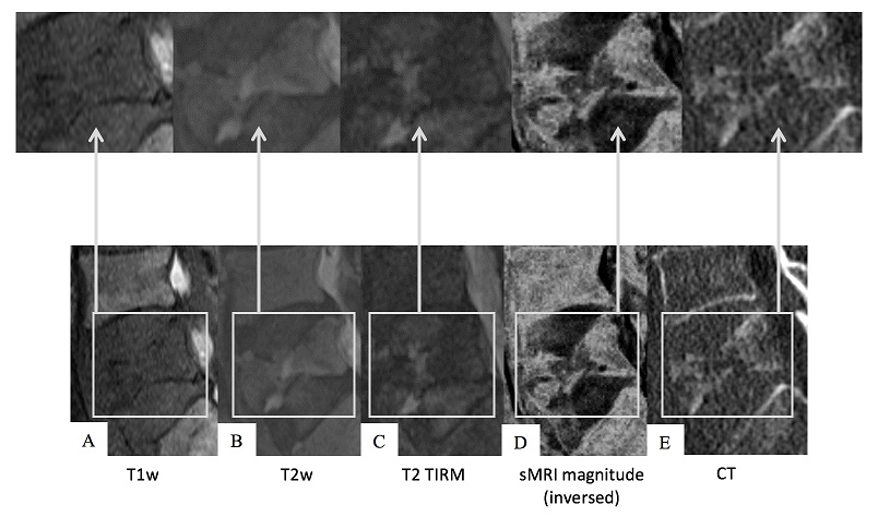 Should we perform susceptibility weighted MRI (sMRI) for vertebral fractures?