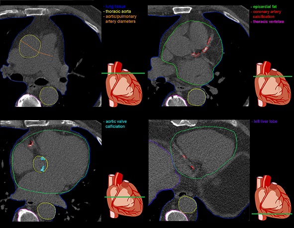 Non-contrast cardiac CT: much more than only calcium scoring!