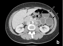 Tricky internal hernias: ten signs to improve your performance