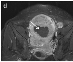 Guidelines for reporting on uterine leiomyoma