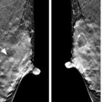Dense breast: tomosynthesis vs MRI. And the winner is…