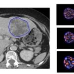 Predicting survival with CT texture analysis in patients with melanoma treated with immunotherapy