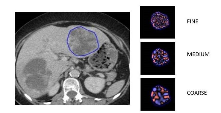 Predicting survival with CT texture analysis in patients with melanoma treated with immunotherapy