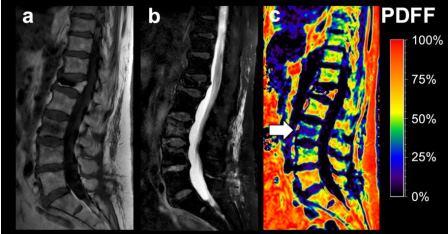 A new tool for the characterization of spine fractures