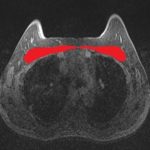 Breast MRI: look around, not only at the gland