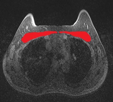 Breast MRI: look around, not only at the gland