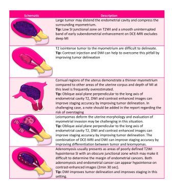 Endometrial cancer guidelines nice