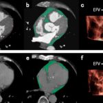 Epicardial fat as an easy predictor of coronary artery disease