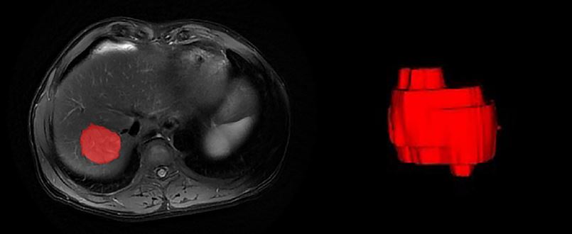 Grading HCC with Radiomics from MRI