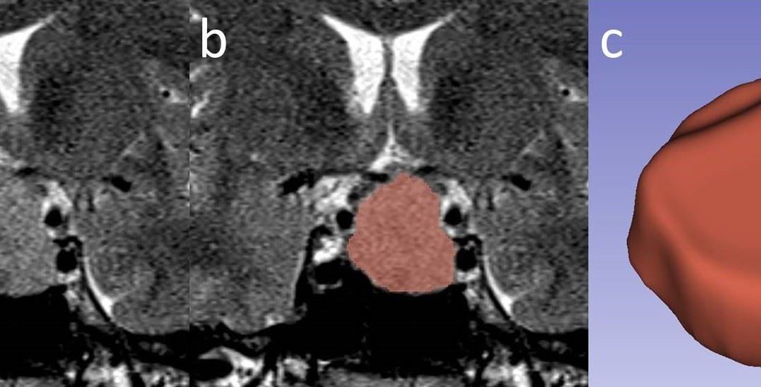 Texture analysis facilitates the follow up of Acromegaly with MRI