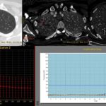 Dual Energy CT and EGFR status in lung cancer