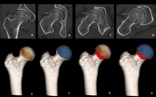 Femoro-acetabular impingement: new developments