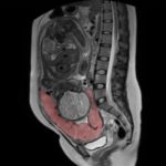 Imaging the placenta: a new frontier?