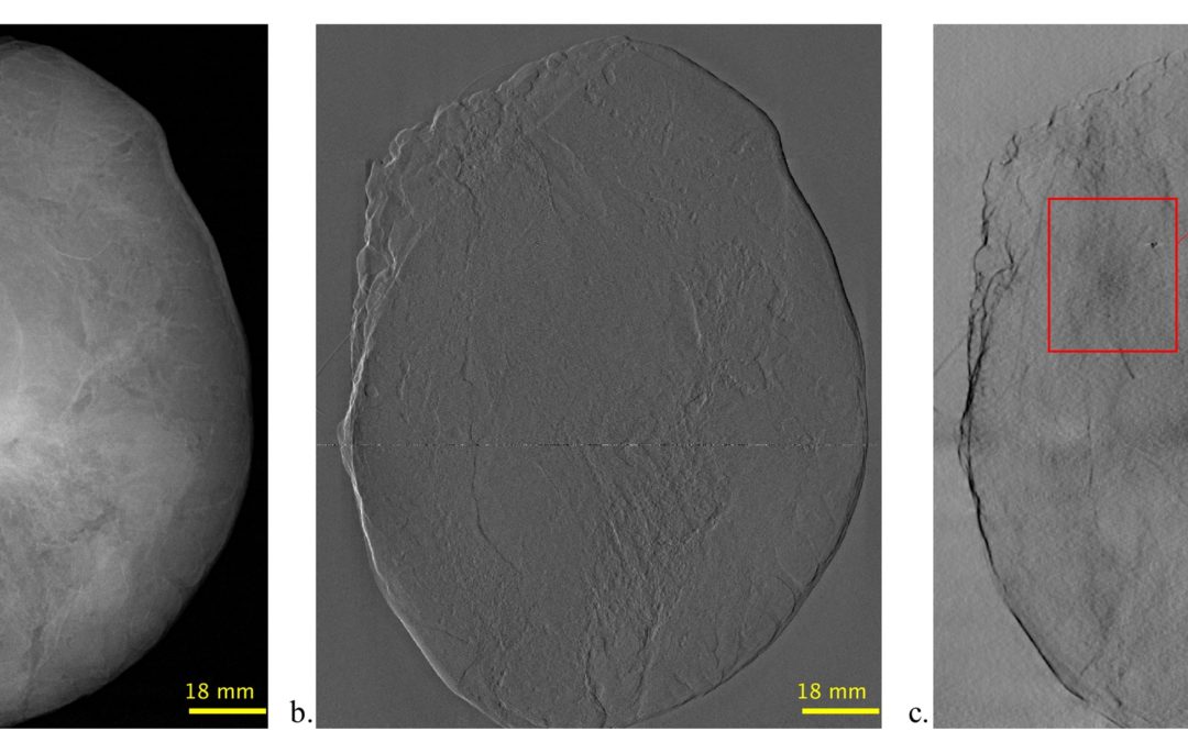 What is grating-interferometry mammography?