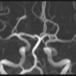 Brain deposition of gadolinium: position statement