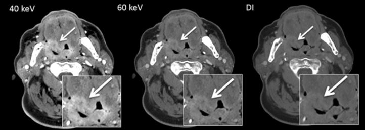Is Dual-Energy CT beneficial for head and neck imaging?