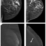 Contrast–enhanced mammography: Is a single view enough?