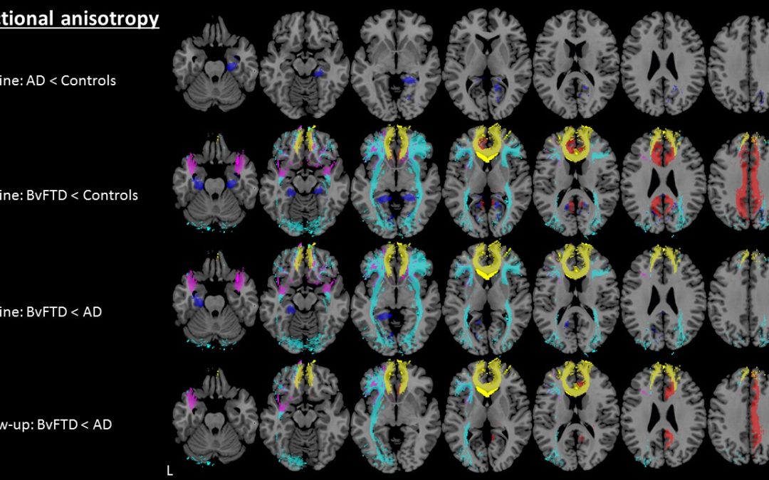 Early diagnosis of dementia with MRI - European Radiology