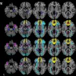 Early diagnosis of dementia with MRI