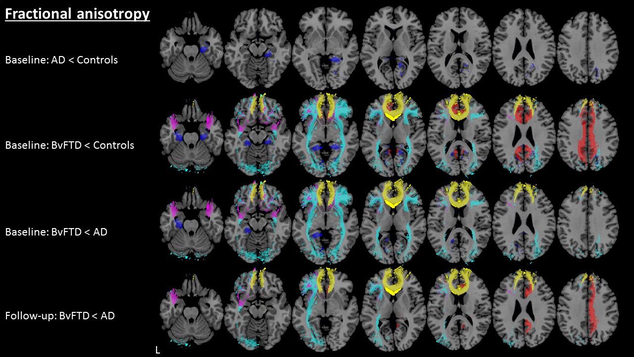 Early diagnosis of dementia with MRI - European Radiology