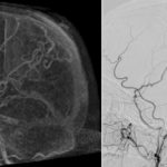 Cranial arterio-venous shunts: the role of 4D-CTA