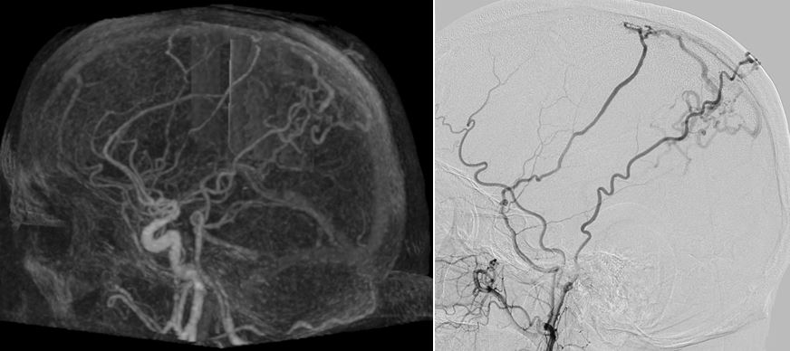 Cranial arterio-venous shunts: the role of 4D-CTA