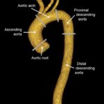 Further imaging tools for aortic acute syndrome