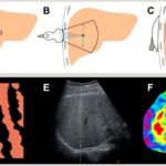 Liver elastography: MR vs US