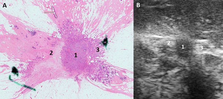 A new method for breast imaging?